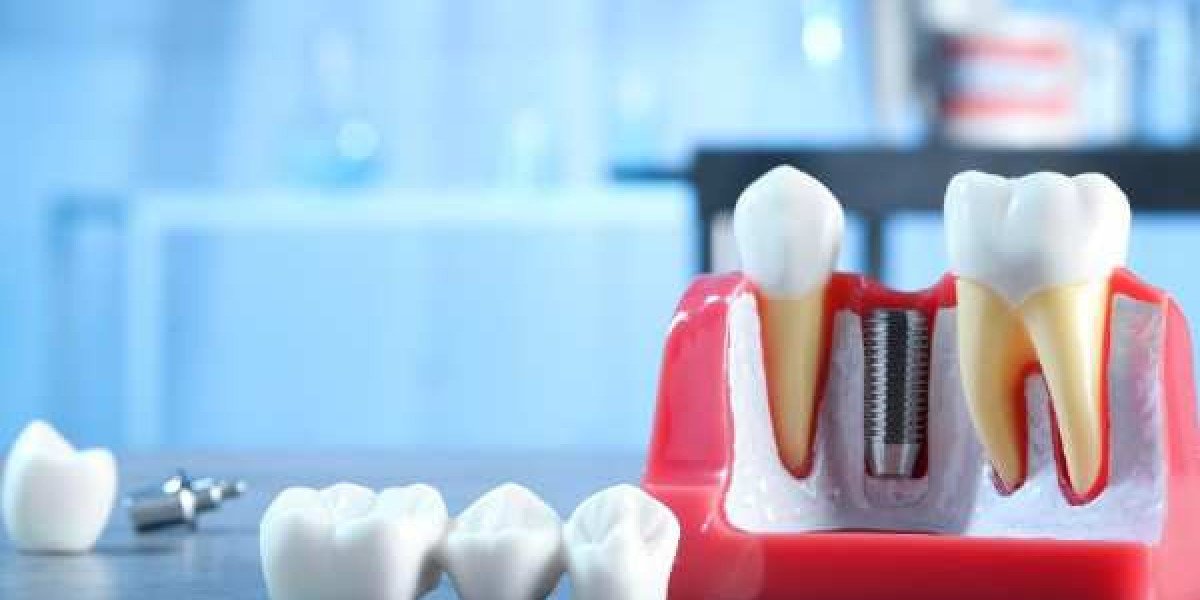 Broken or Lost Tooth? Emergency Implants Provide Rapid Repair